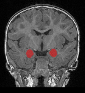 Amygdala: MRT-Scans zeigen deutliche Vergrößerung (Foto: CIDD at UNC-CH)