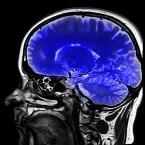 Gehirn: Glioblatome sind bislang kaum behandelbar (Foto: pixabay.com kalhh)