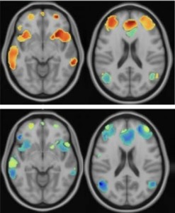 Menschliches Gehirn vor und nach der TMS-Behandlung (Fotos: Nolan Williams Lab)