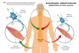 So wirkt das neue Medikament gegen ALS (Infografik: Spinogenix)