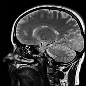 Gehirn im Scan: Neuer Behandlungsansatz bringt Hoffnung für Betroffene (Foto: pixabay.com, kalhh)