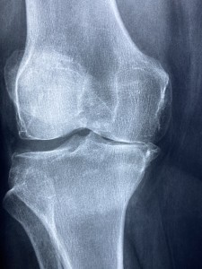 Arthritis: Entzündungen schaden der Kognition (Foto: pixabay.com, Dr. Manuel Gonzalez Reyes)